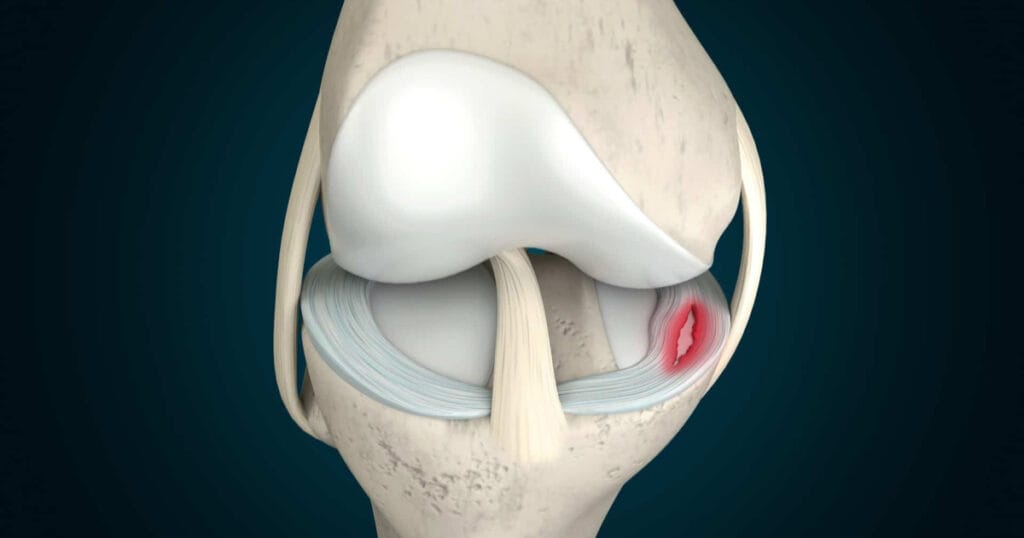 Menisküs Yaralanmaları