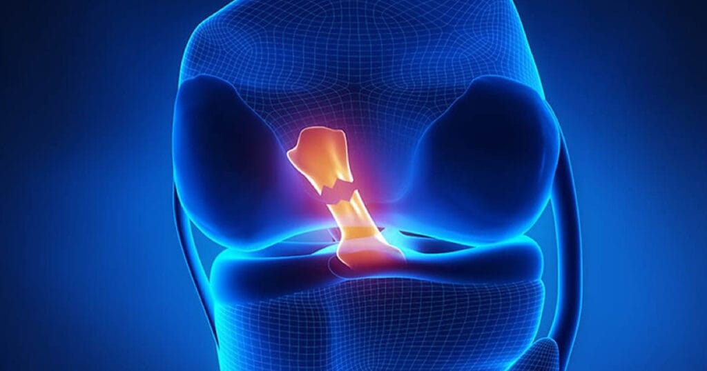 Ön Çapraz Bağ Yaralanması